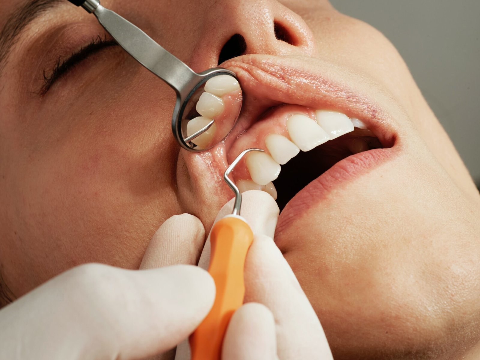 Image illustrant la parodontie dentaire